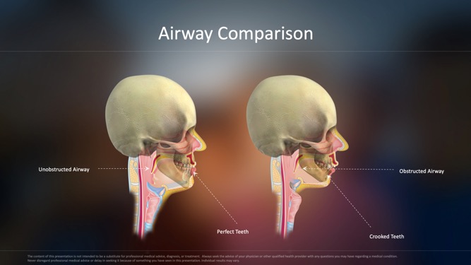 Airway Comparison