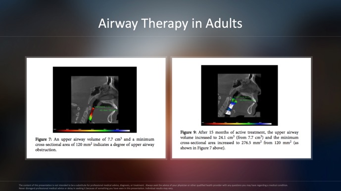 Airway Therapy in Adults