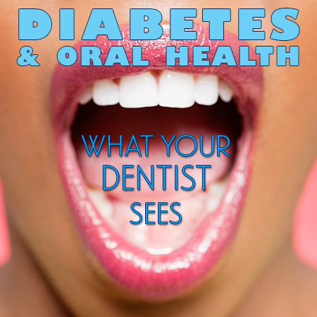 San Luis Obispo dentist, Michael Colleran DDS, discusses the side effects of diabetes and how it affects your oral health.