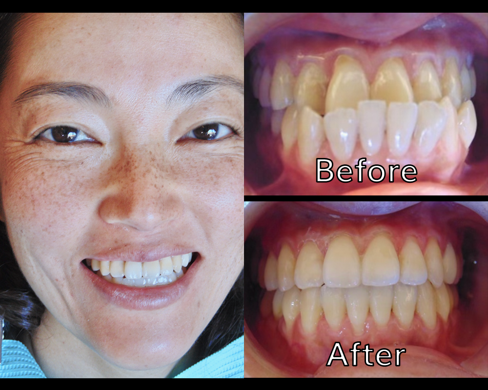 Clear Braces Wall Twp NJ  Straighten Teeth with Invisalign Clear