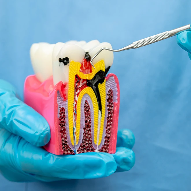 Root Canal Model