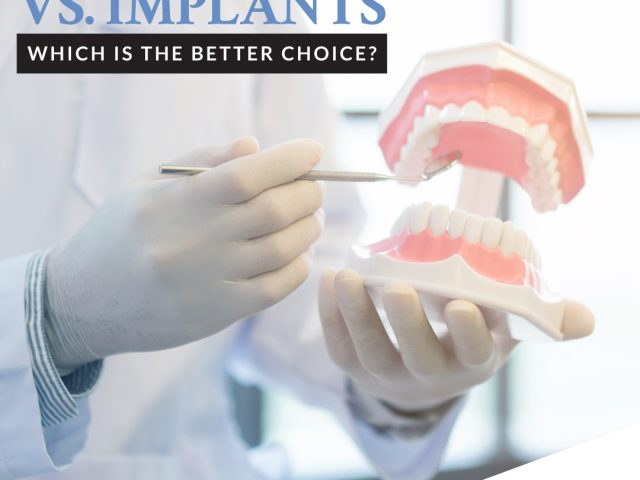 Dentures vs. Implants: Which is the Better Choice? (featured image)