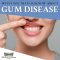 What You Need to Know About Gum Disease in San Luis Obispo (featured image)