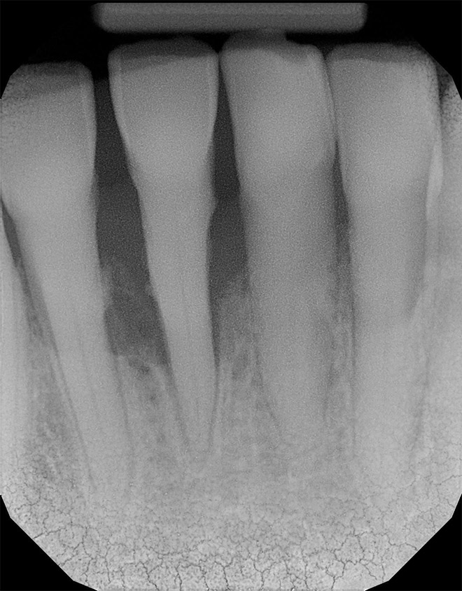 Front-Lower (Before)