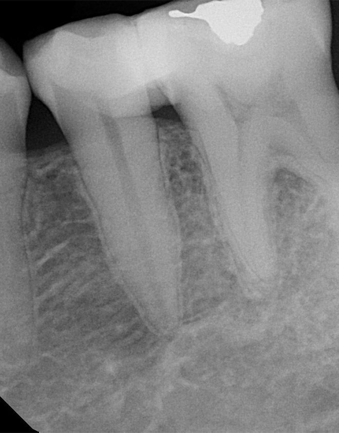 Molar (After)